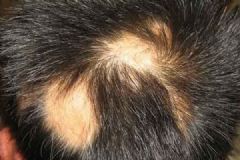 15歲為什么會(huì)掉頭發(fā)？15歲脫發(fā)是什么原因？[多圖]