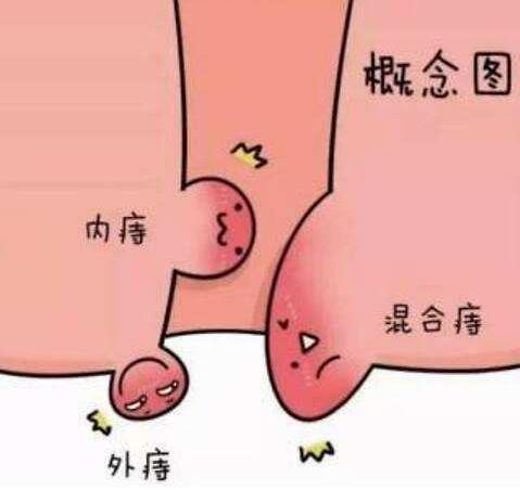 女性痔瘡真人實拍圖片 痔瘡的臨床表現及有效治痔瘡的小偏方