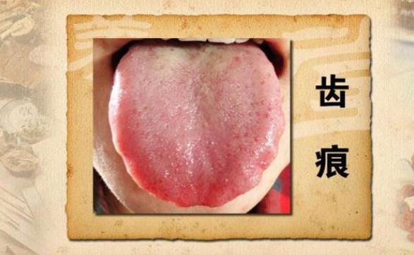 濕氣重舌苔是什么樣的 齒痕發白發黃厚實