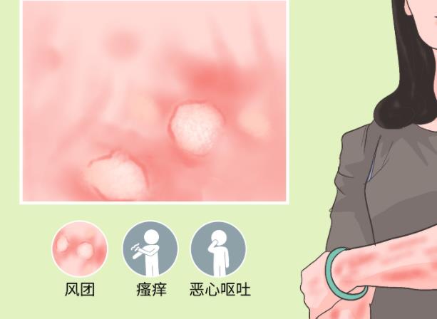 蕁麻疹會引起發燒嗎 哪種蕁麻疹會引起發燒