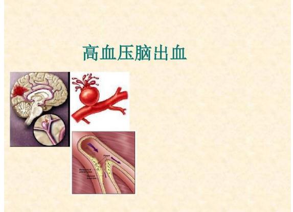 高血壓為什么會引起腦出血？高血脂會引起高血壓嗎？