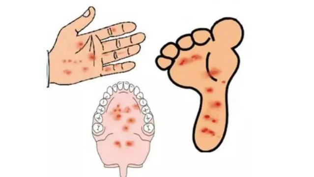 兒童手足口病皮疹需注意哪些？手足口病手上泡抓爛了怎么辦？