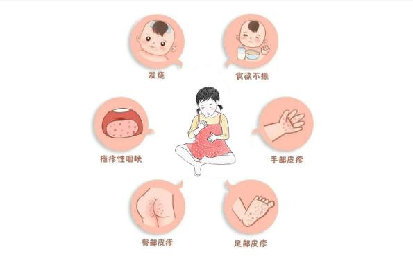 手足口病會(huì)傳染給大人嗎？手足口病潛伏期有多久？