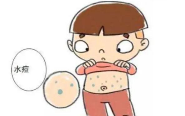 水痘怎樣好得快？出水痘有什么先兆癥狀嗎？