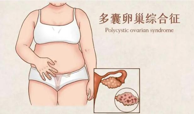 多囊卵巢綜合征的自我治療 ？多囊卵巢綜合癥的病因有什么？