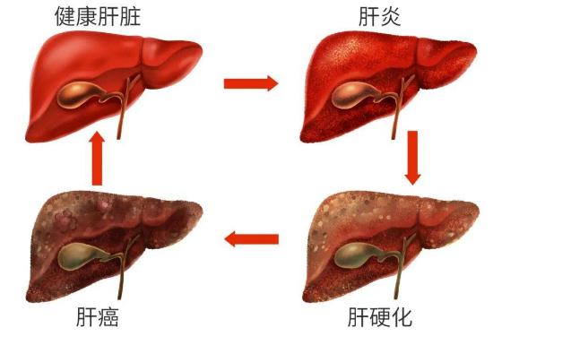 酒精肝如何治療？酒精肝會腹瀉嗎？