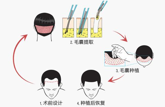 植發可以改善自然卷嗎 轉移毛囊不能改變基因