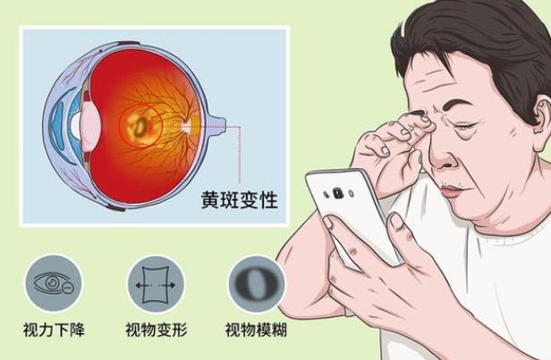 并發性白內障怎么治療 白內障手術晶體植入后注意什么