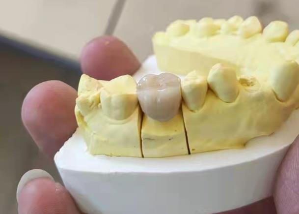 烤瓷牙和全瓷牙有哪些區別 全瓷牙是什么