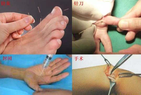 腱鞘炎術后疼嗎 腱鞘炎手術后會復發嗎