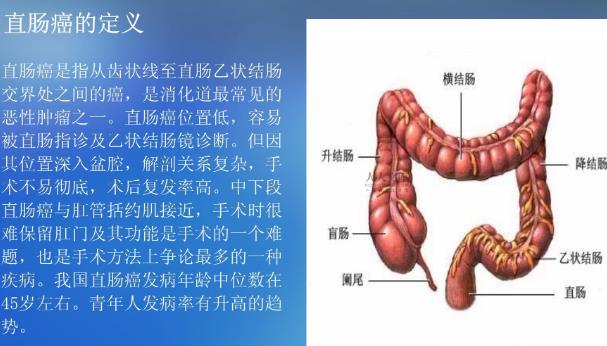 直腸癌微創手術怎么做 直腸癌早期手術有效嗎