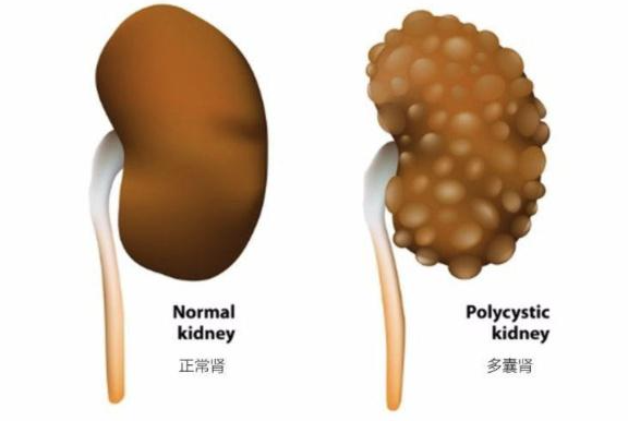 腎囊腫與多囊腎有哪些區別 多囊腎有哪些癥狀